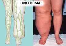 linfedema